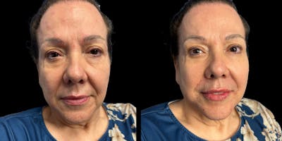 Fillers Before & After Gallery - Patient 303414 - Image 1