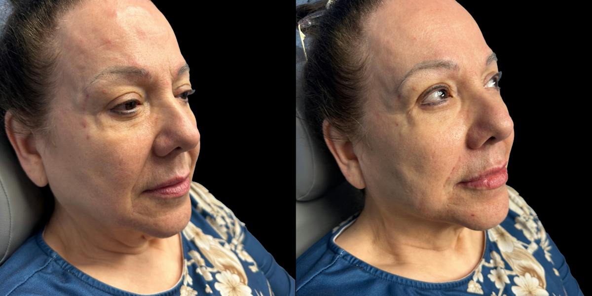 Fillers Before & After Gallery - Patient 303414 - Image 2