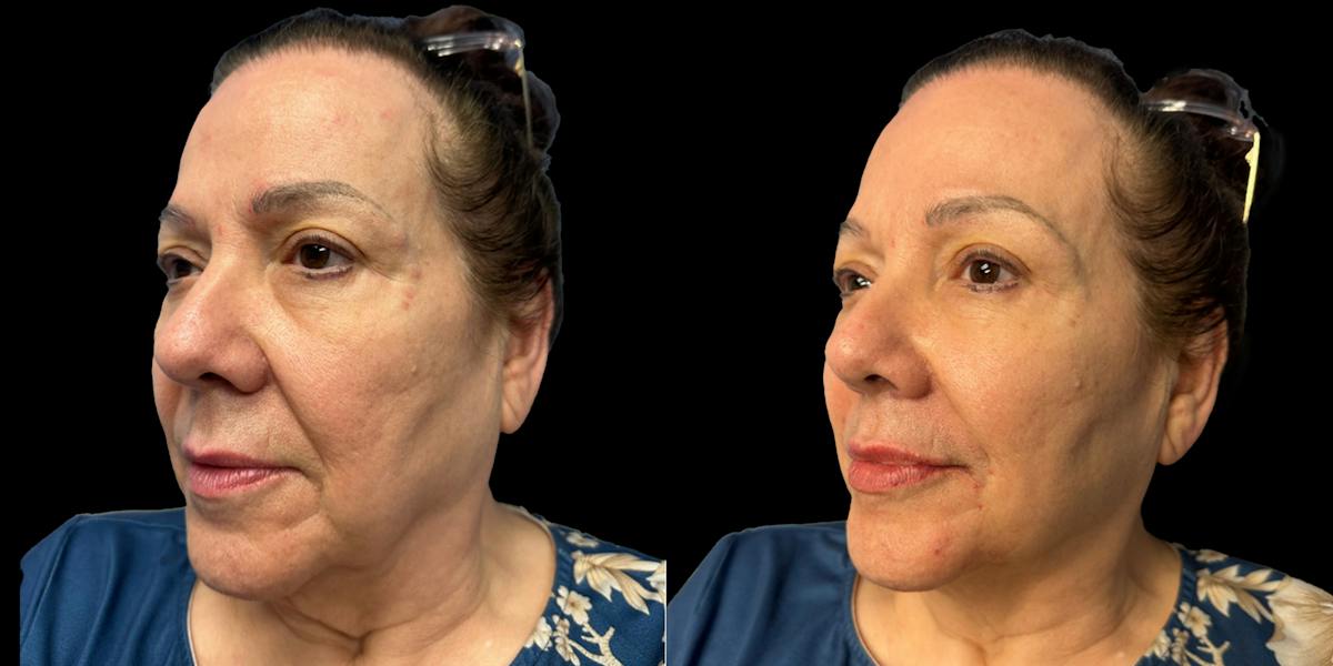 Fillers Before & After Gallery - Patient 303414 - Image 3