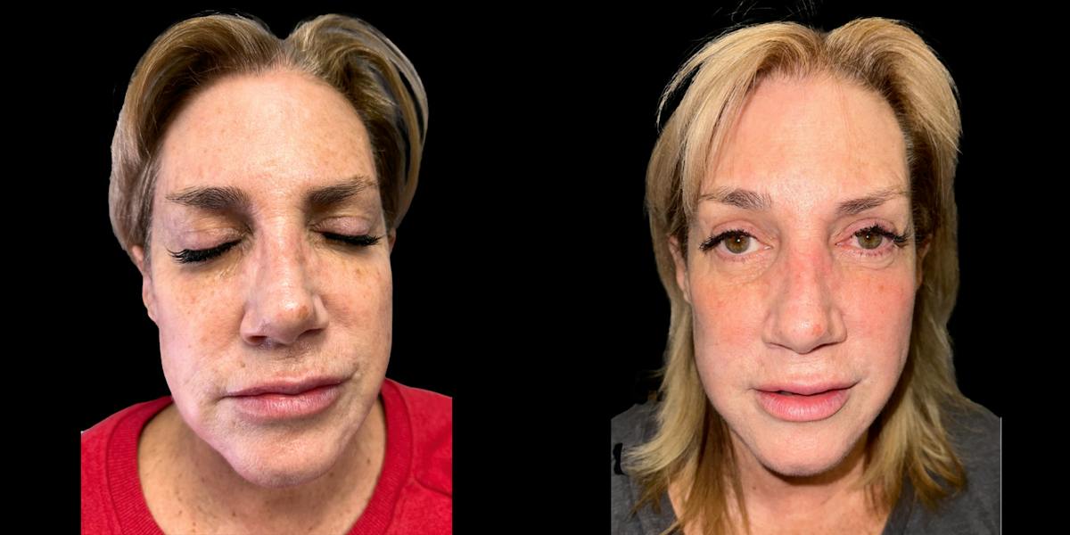 Laser Skin Rejuvenation  Before & After Gallery - Patient 282016 - Image 1