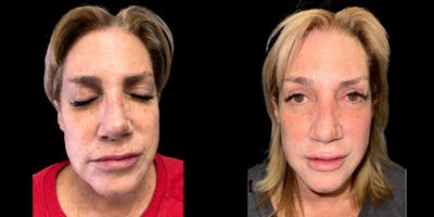 Laser Skin Rejuvenation  Before & After Gallery - Patient 282016 - Image 1