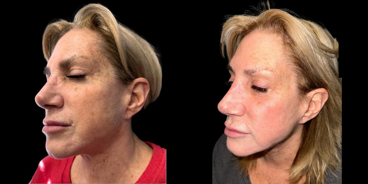 Laser Skin Rejuvenation  Before & After Gallery - Patient 282016 - Image 3
