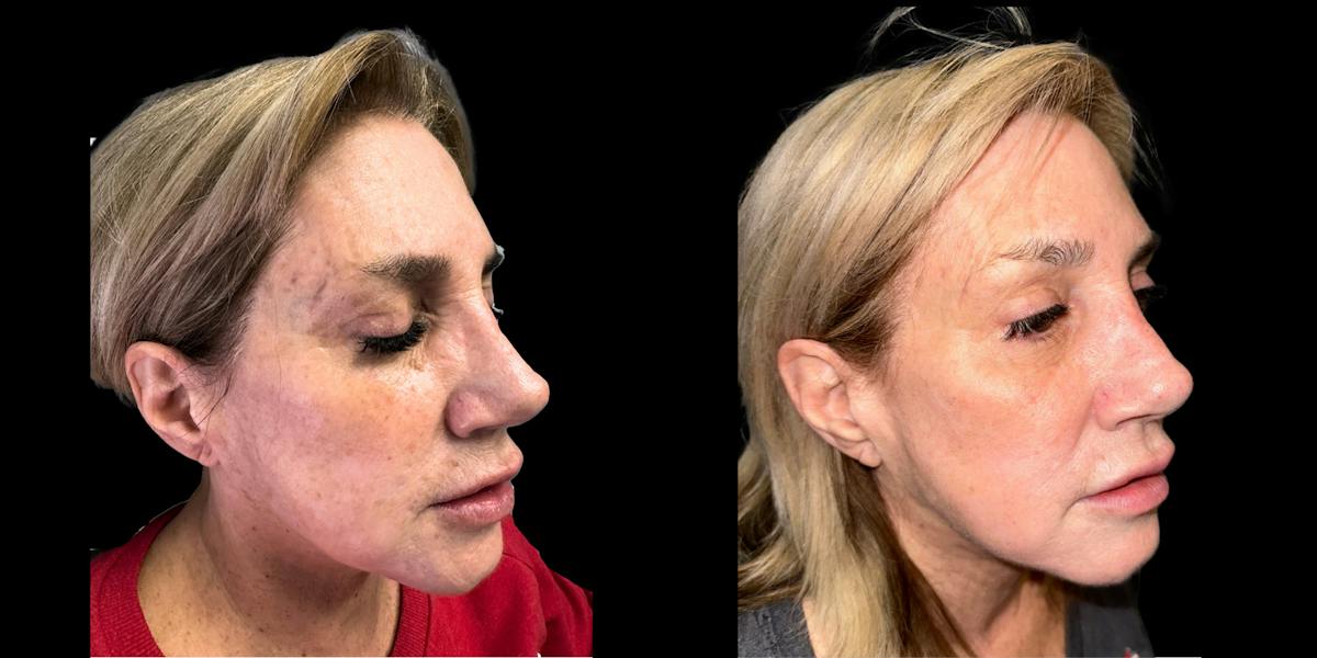 Laser Skin Rejuvenation  Before & After Gallery - Patient 282016 - Image 2