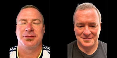 Laser Skin Rejuvenation  Before & After Gallery - Patient 188683 - Image 1