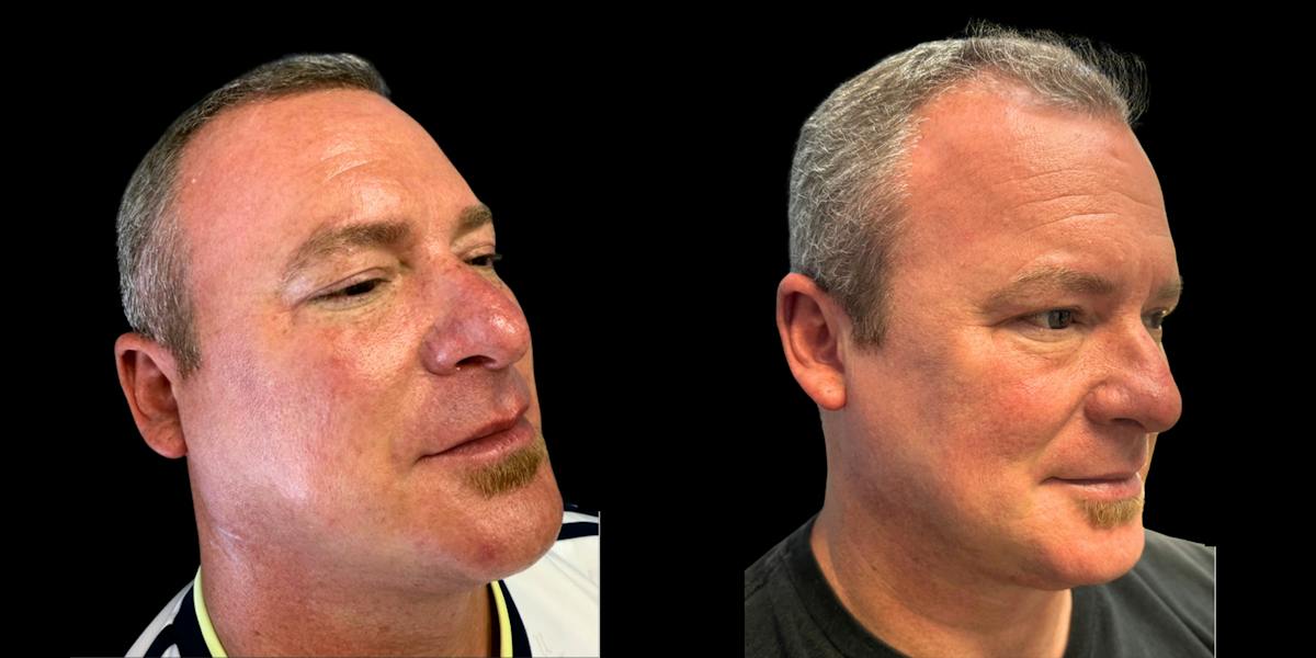Laser Skin Rejuvenation  Before & After Gallery - Patient 188683 - Image 2