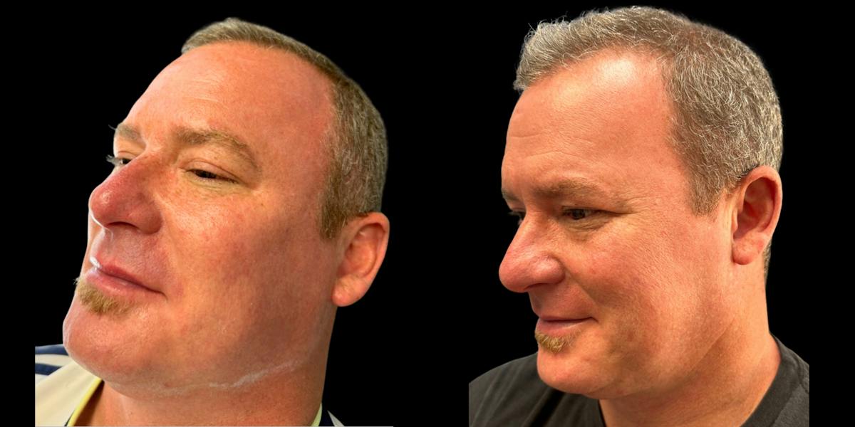 Laser Skin Rejuvenation  Before & After Gallery - Patient 188683 - Image 3