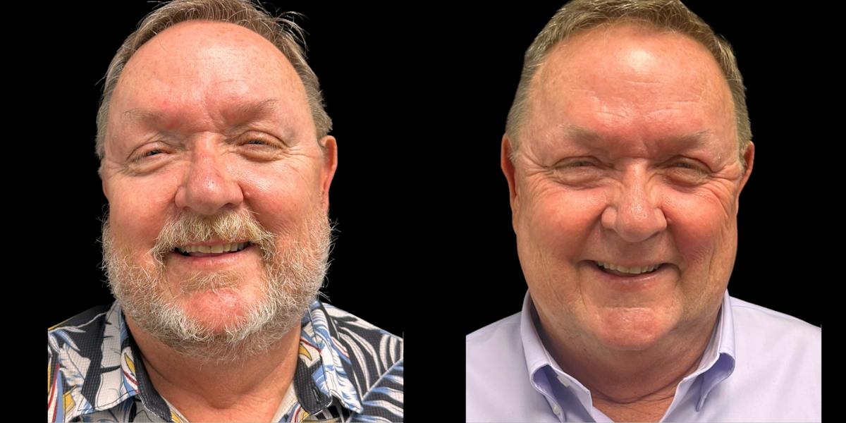 Laser Skin Rejuvenation  Before & After Gallery - Patient 242519 - Image 1