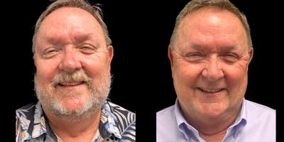 Laser Skin Rejuvenation  Before & After Gallery - Patient 242519 - Image 1