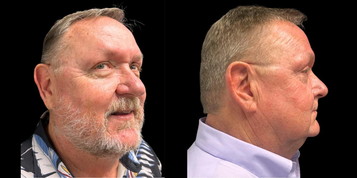 Laser Skin Rejuvenation  Before & After Gallery - Patient 242519 - Image 2