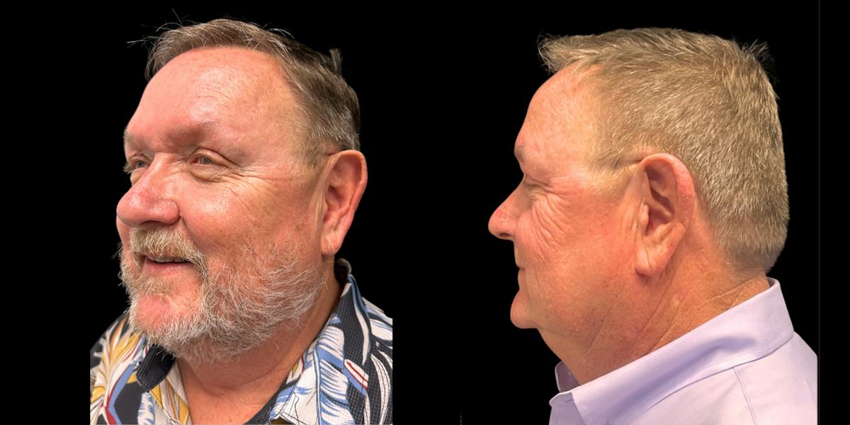 Laser Skin Rejuvenation  Before & After Gallery - Patient 242519 - Image 3