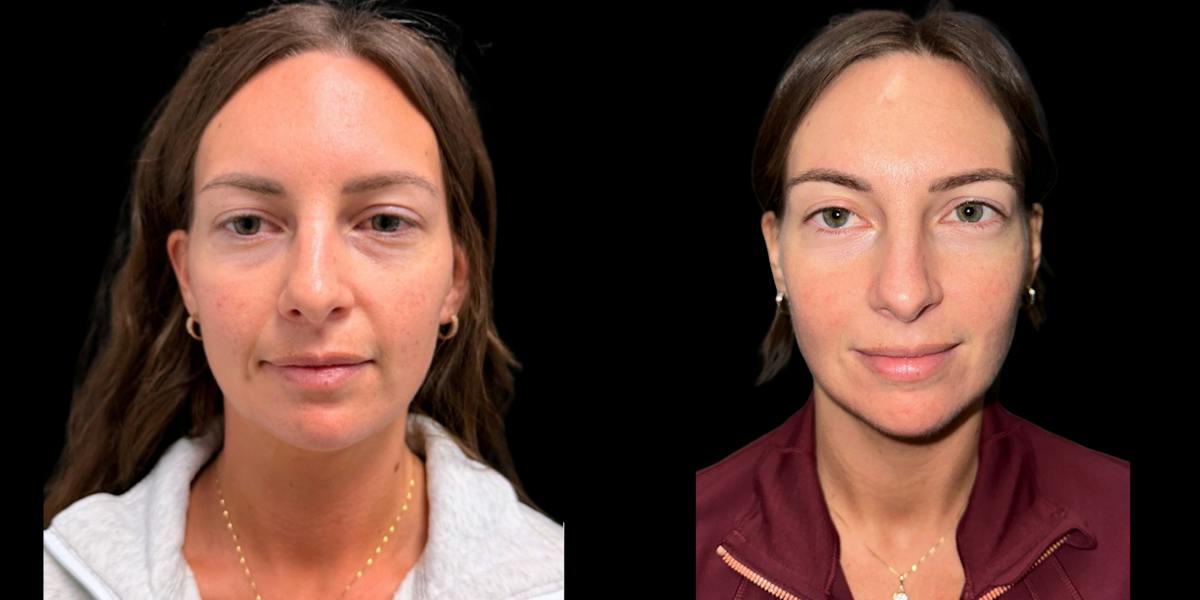Laser Skin Rejuvenation  Before & After Gallery - Patient 234842 - Image 1