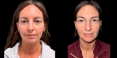 Laser Skin Rejuvenation  Before & After Gallery - Patient 234842 - Image 1