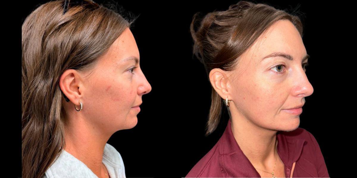 Laser Skin Rejuvenation  Before & After Gallery - Patient 234842 - Image 2