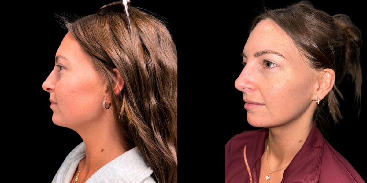 Laser Skin Rejuvenation  Before & After Gallery - Patient 234842 - Image 3