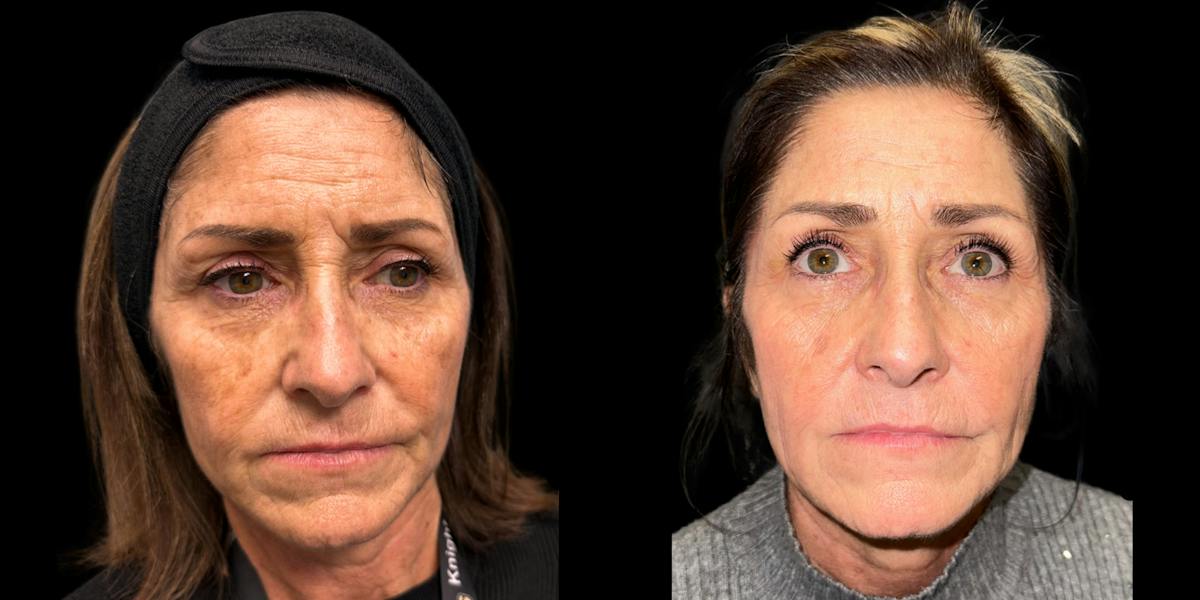 Laser Skin Rejuvenation  Before & After Gallery - Patient 492765 - Image 1
