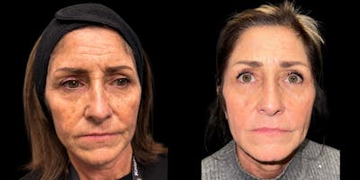 Laser Skin Rejuvenation  Before & After Gallery - Patient 492765 - Image 1
