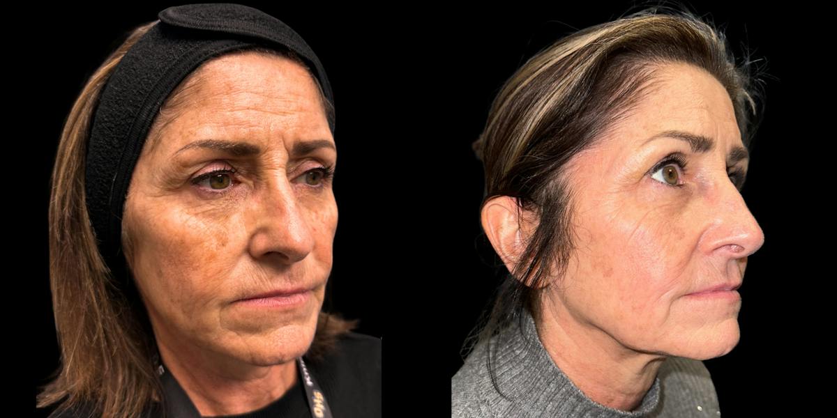 Laser Skin Rejuvenation  Before & After Gallery - Patient 492765 - Image 2