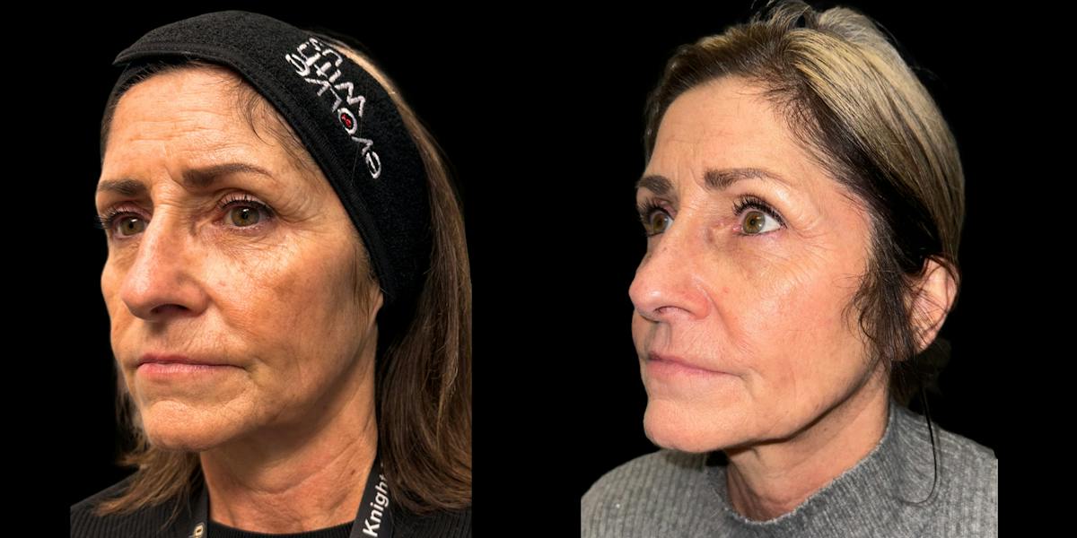 Laser Skin Rejuvenation  Before & After Gallery - Patient 492765 - Image 3