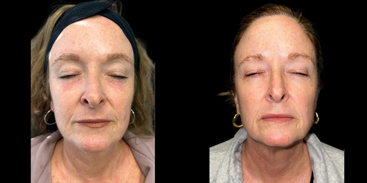 Laser Skin Rejuvenation  Before & After Gallery - Patient 217976 - Image 1