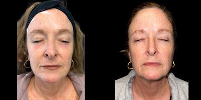 Laser Skin Rejuvenation  Before & After Gallery - Patient 217976 - Image 1