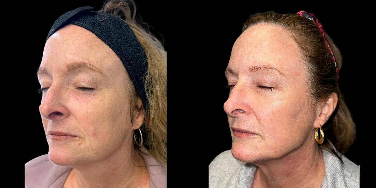 Laser Skin Rejuvenation  Before & After Gallery - Patient 217976 - Image 2