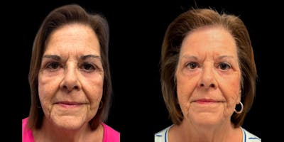 Laser Skin Rejuvenation  Before & After Gallery - Patient 428973 - Image 1