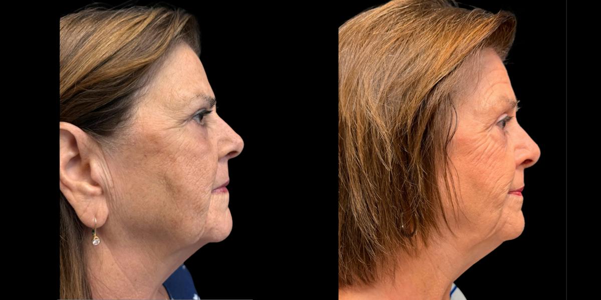 Laser Skin Rejuvenation  Before & After Gallery - Patient 428973 - Image 2