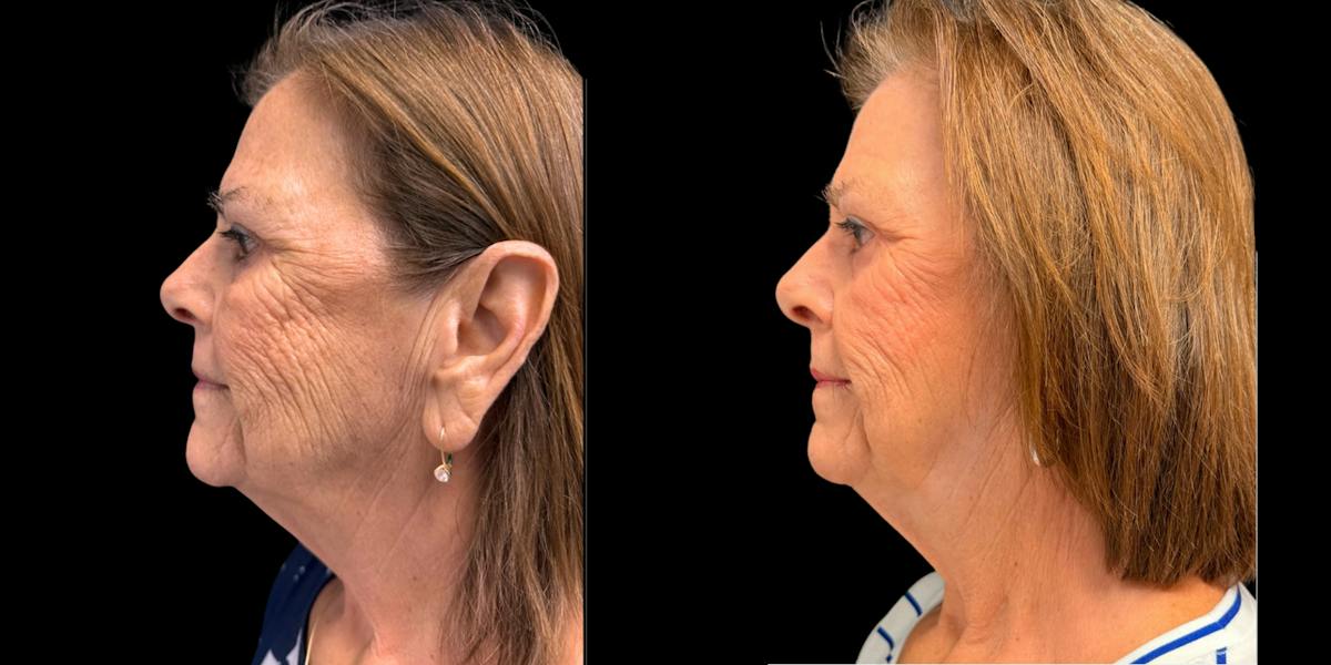 Laser Skin Rejuvenation  Before & After Gallery - Patient 428973 - Image 3