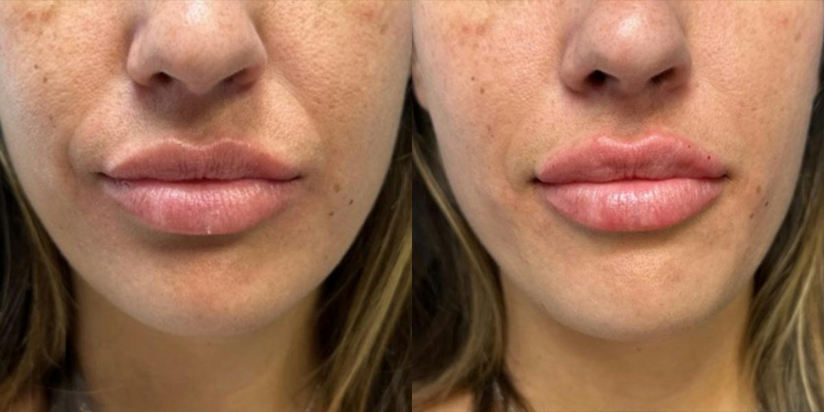 Lip Filler Before & After Gallery - Patient 384368 - Image 1