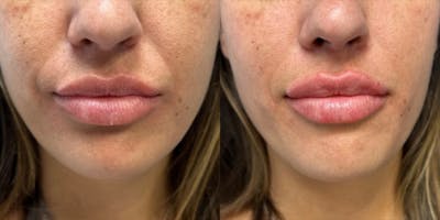 Lip Filler Before & After Gallery - Patient 384368 - Image 1