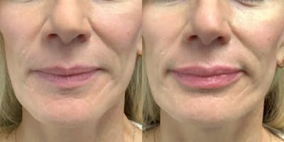 Lip Filler Before & After Gallery - Patient 308014 - Image 1