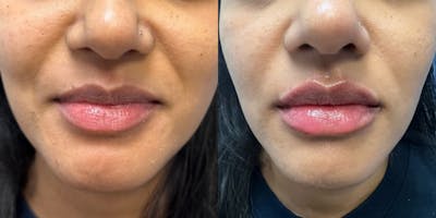 Lip Filler Before & After Gallery - Patient 159140 - Image 1