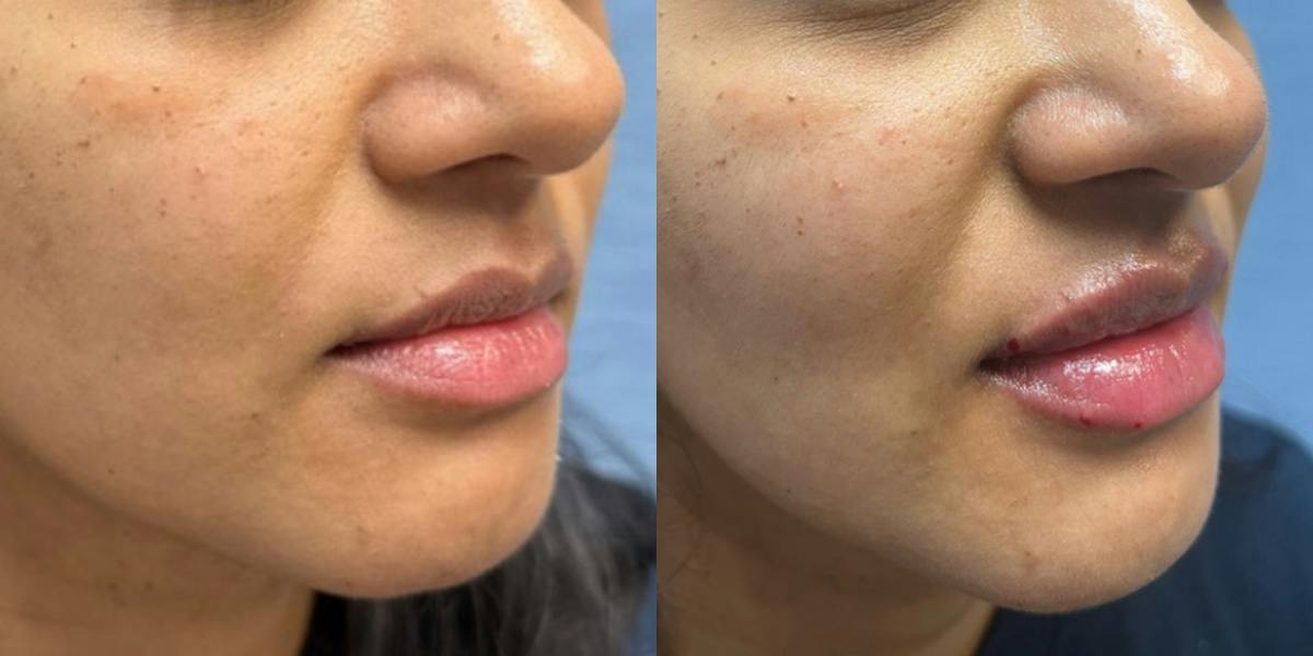 Lip Filler Before & After Gallery - Patient 159140 - Image 2