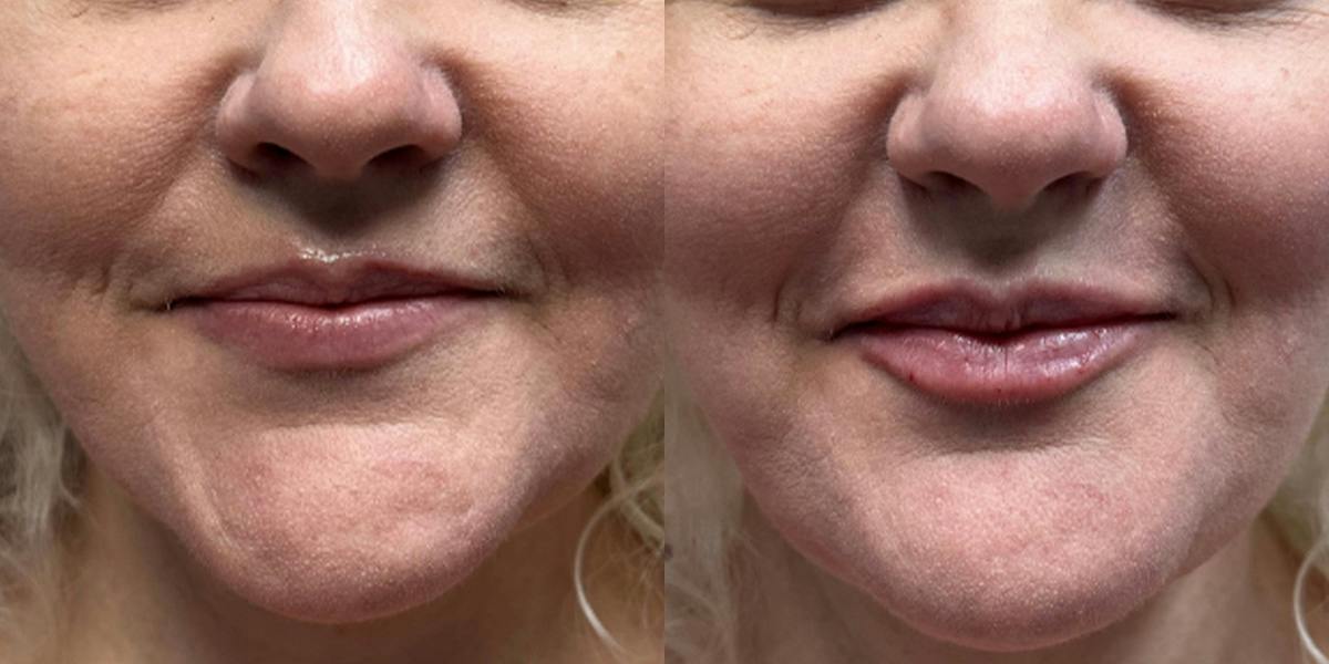 Lip Filler Before & After Gallery - Patient 234881 - Image 1