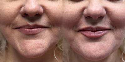 Lip Filler Before & After Gallery - Patient 234881 - Image 1