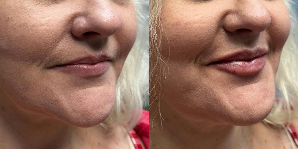Lip Filler Before & After Gallery - Patient 234881 - Image 2