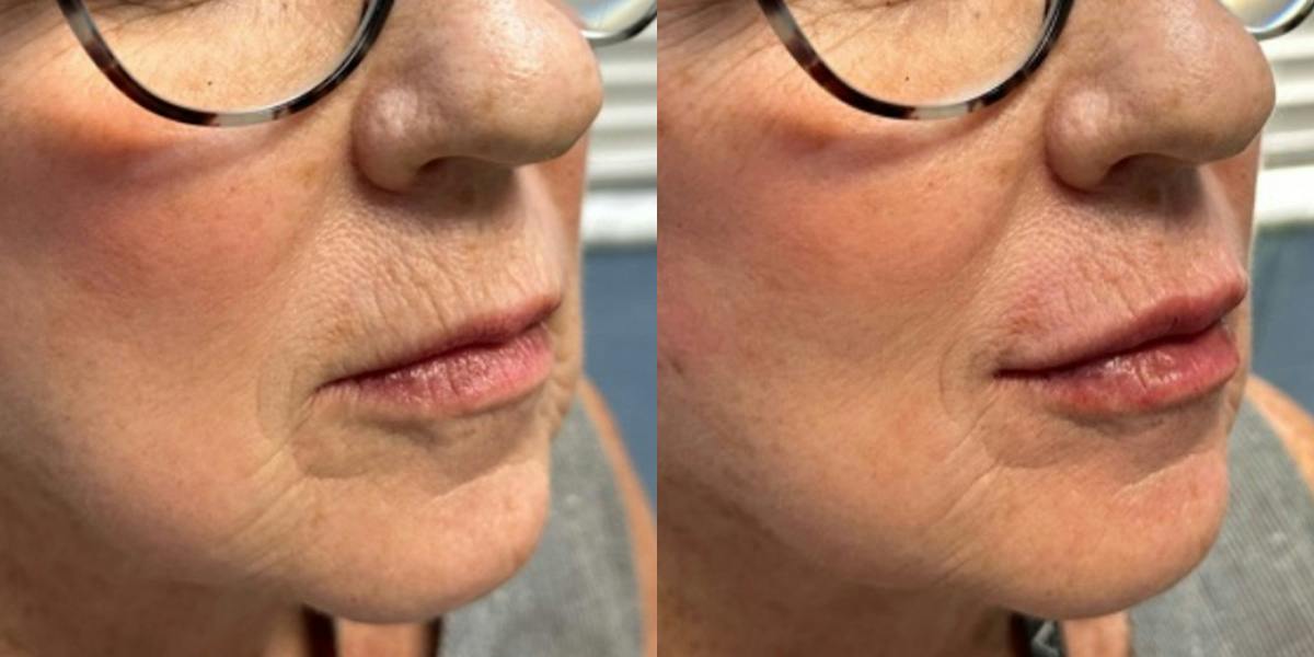 Lip Filler Before & After Gallery - Patient 901630 - Image 1