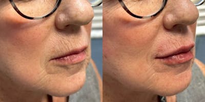 Lip Filler Before & After Gallery - Patient 901630 - Image 1
