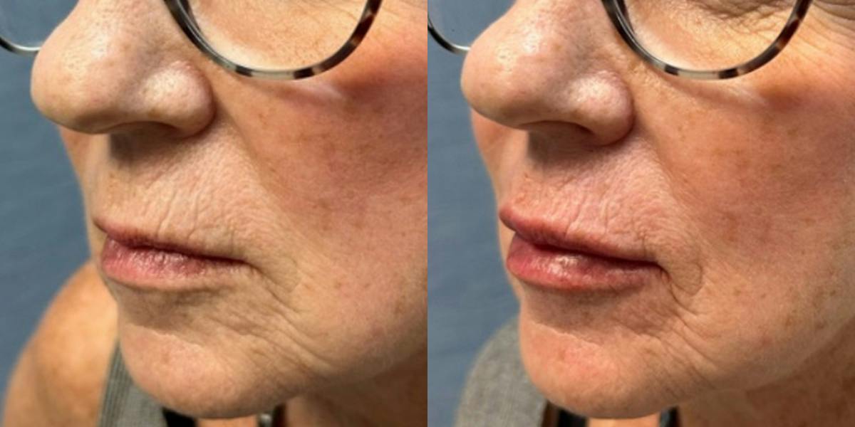 Lip Filler Before & After Gallery - Patient 901630 - Image 2