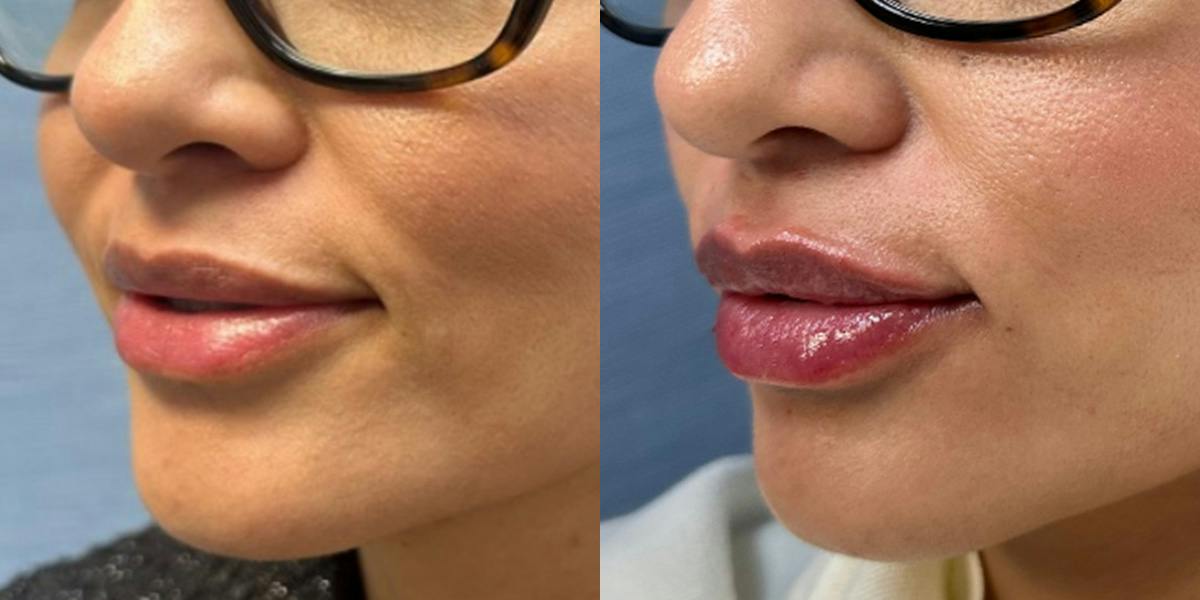 Lip Filler Before & After Gallery - Patient 463498 - Image 1