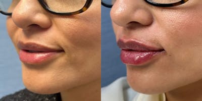 Lip Filler Before & After Gallery - Patient 463498 - Image 1