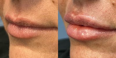 Lip Filler Before & After Gallery - Patient 189945 - Image 1