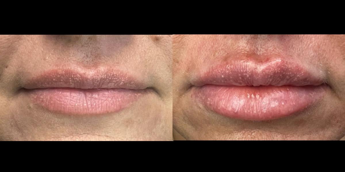 Lip Filler Before & After Gallery - Patient 905142 - Image 1
