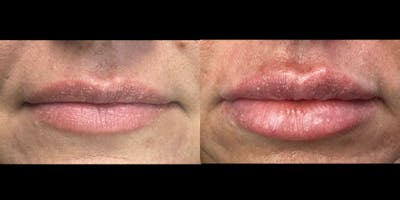 Lip Filler Before & After Gallery - Patient 905142 - Image 1