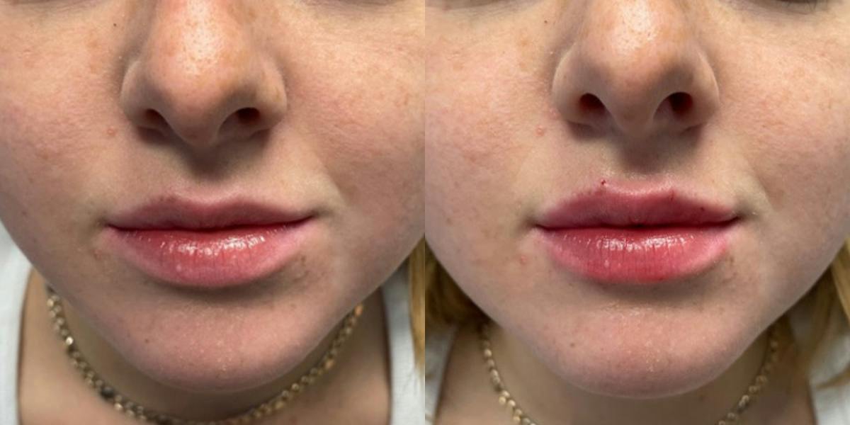 Lip Filler Before & After Gallery - Patient 371684 - Image 1