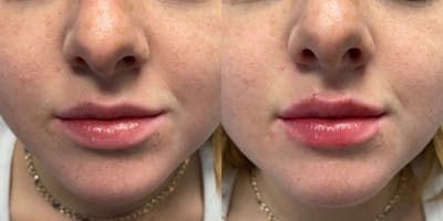 Lip Filler Before & After Gallery - Patient 371684 - Image 1