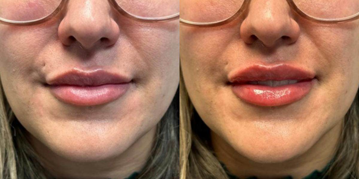 Lip Filler Before & After Gallery - Patient 146939 - Image 1