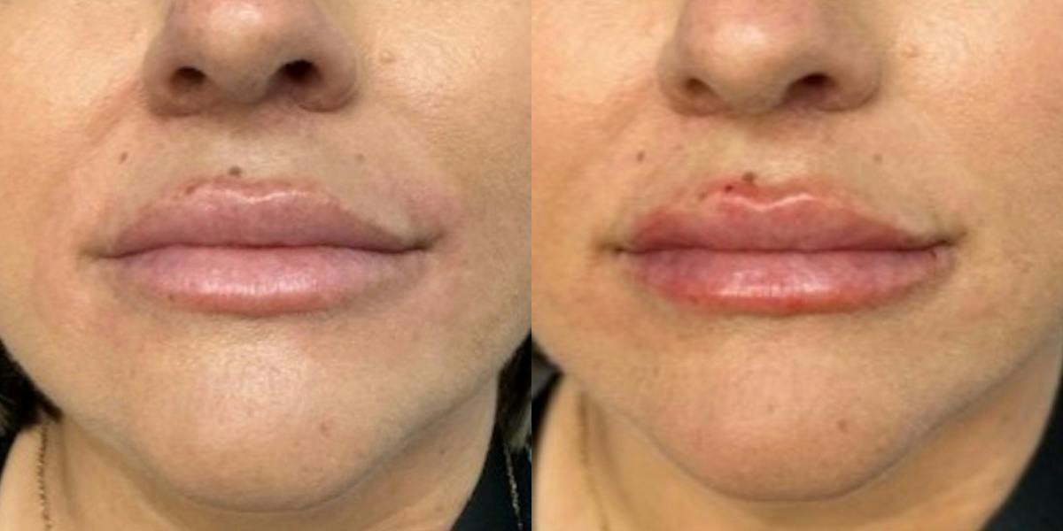 Lip Filler Before & After Gallery - Patient 219464 - Image 1