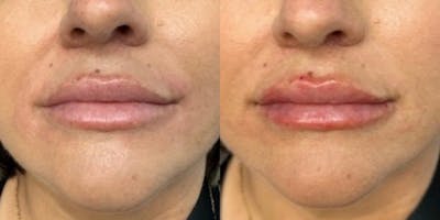 Lip Filler Before & After Gallery - Patient 219464 - Image 1