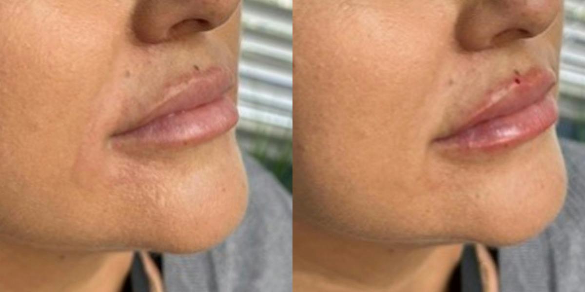 Lip Filler Before & After Gallery - Patient 219464 - Image 3